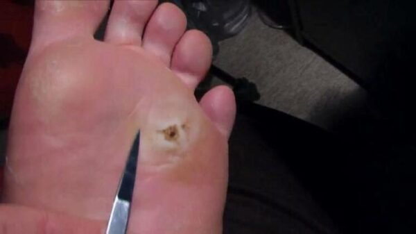 Kaki Bengkak Dan Ada Mata Ikan? Jangan Panik, Ini Cara Mengobatinya