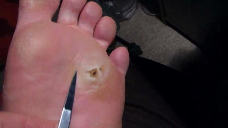 142- mata ikan Kaki Bengkak Dan Ada Mata Ikan? Jangan Panik, Ini Cara Mengobatinya