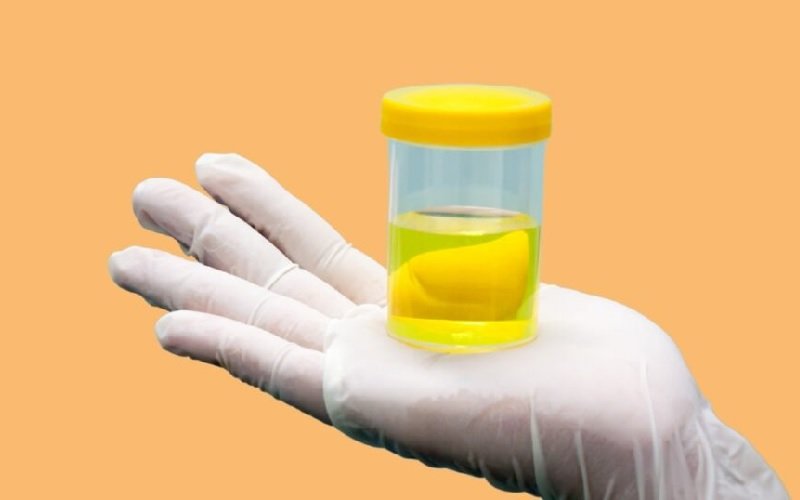 Sering Dianggap Remeh, Ini Pengaruh Urine Terhadap Kesehatan Ginjal
