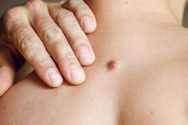 Mengenal Dermatofibroma, Benjolan Kecil di Kulit yang Sebenarnya Adalah Tumor