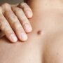 Mengenal Dermatofibroma, Benjolan Kecil di Kulit yang Sebenarnya Adalah Tumor