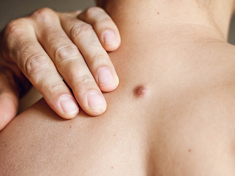 059-Benjolan di punggung akibat Dermatofibroma Mengenal Dermatofibroma, Benjolan Kecil di Kulit yang Sebenarnya Adalah Tumor