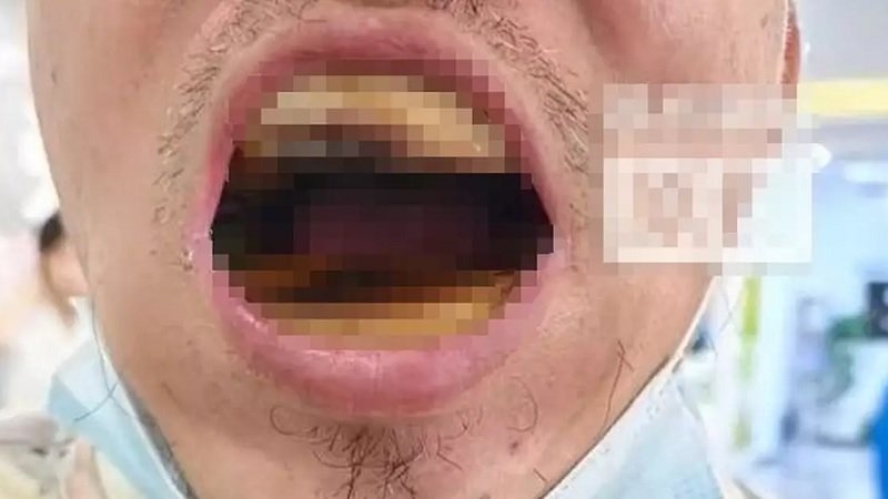 Niat Hemat Malah Apes, Pria China Ini Terancam Ompong Total Gara-Gara Bikin Gigi Palsu Sendiri