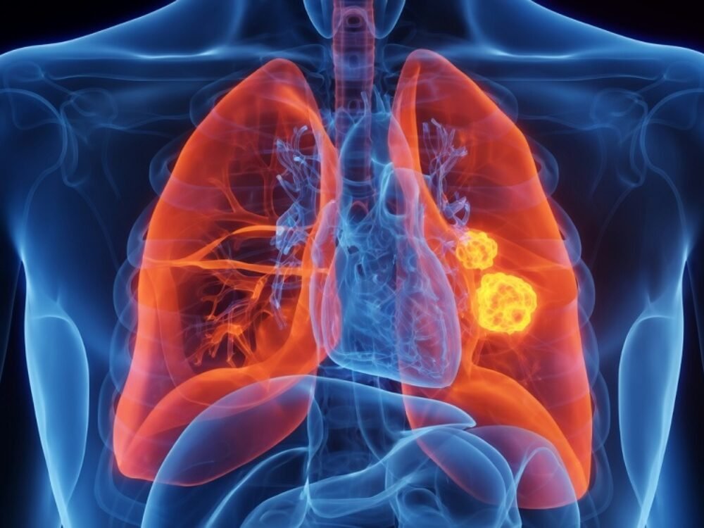 Kanker Paru-paru Sel Kecil Cepat Kambuh dan Sulit Diobati? Ini Penjelasannya