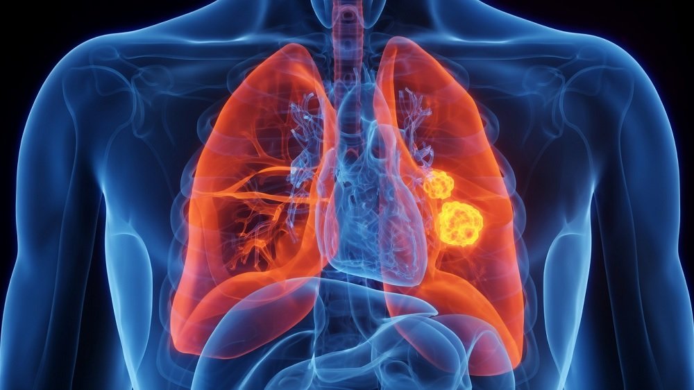 090-Ilustrasi sel kanker paru-paru Kanker Paru-paru Sel Kecil Cepat Kambuh dan Sulit Diobati? Ini Penjelasannya